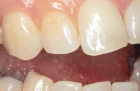 After picture of a tooth with repaired tooth filling