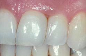 After composite bonding applied to tooth gap