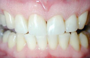after of patient's teeth with veneers