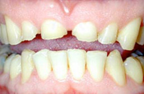 Before picture of a discolored tooth filling