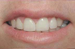 closeup of composite bonding applied to teeth to fix gap
