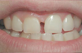 closeup of uneven gum tissue and spaced front teeth
