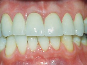 closeup of natural looking dental crown on patient