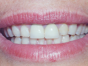 closeup of womans mouth with bad teeth
