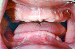 Dentures 2 - Before