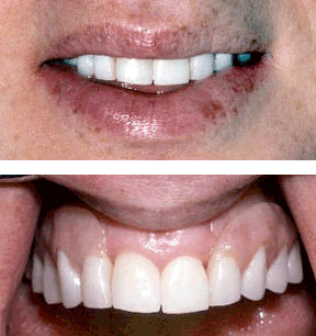 Dentures 5 - Before