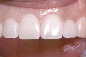 Closeup of a human mouth with veneers