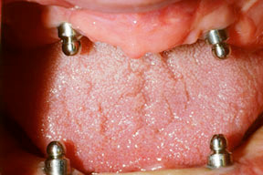 closeup of dental patient's mouth with no teeth