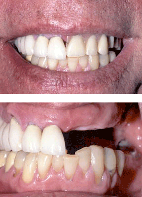 Closeup of patient wearing removable partial denture